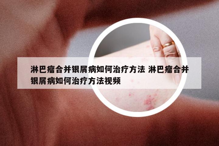 淋巴瘤合并银屑病如何治疗方法 淋巴瘤合并银屑病如何治疗方法视频