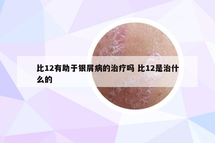 比12有助于银屑病的治疗吗 比12是治什么的