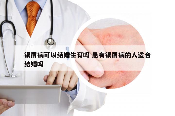 银屑病可以结婚生育吗 患有银屑病的人适合结婚吗