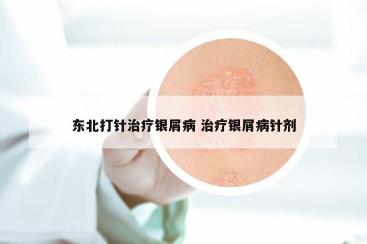 东北打针治疗银屑病 治疗银屑病针剂