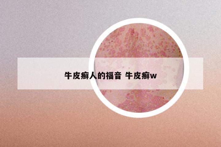 牛皮癣人的福音 牛皮癣w