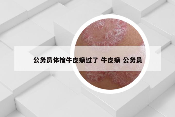 公务员体检牛皮癣过了 牛皮癣 公务员