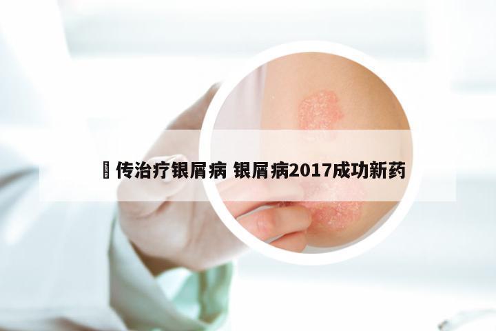 袓传治疗银屑病 银屑病2017成功新药