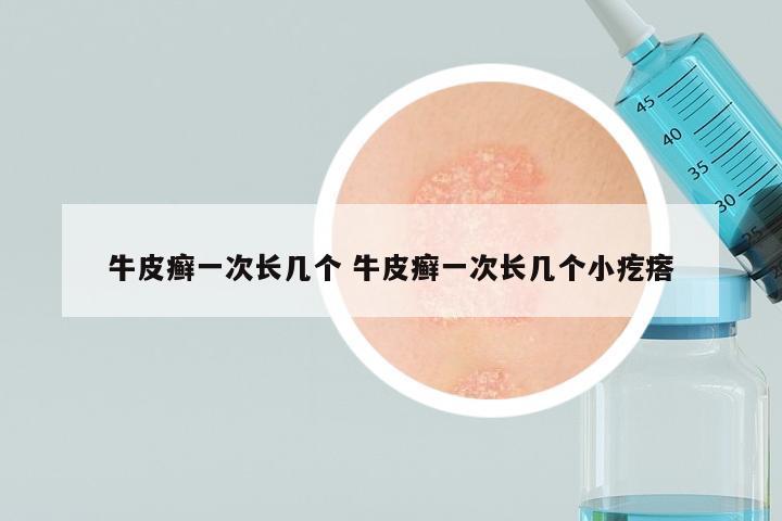 牛皮癣一次长几个 牛皮癣一次长几个小疙瘩