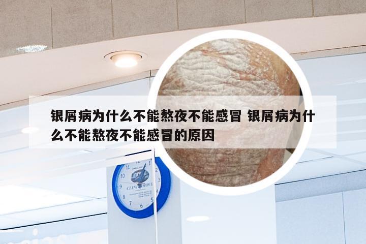 银屑病为什么不能熬夜不能感冒 银屑病为什么不能熬夜不能感冒的原因
