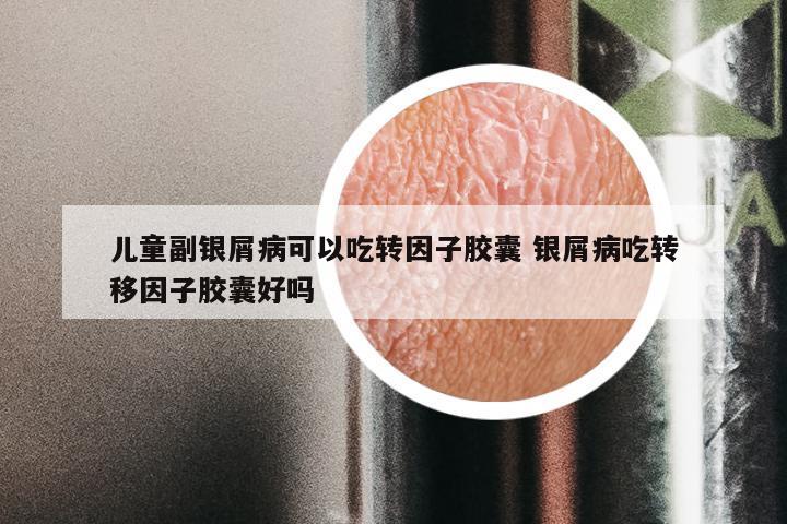 儿童副银屑病可以吃转因子胶囊 银屑病吃转移因子胶囊好吗