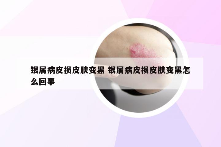 银屑病皮损皮肤变黑 银屑病皮损皮肤变黑怎么回事