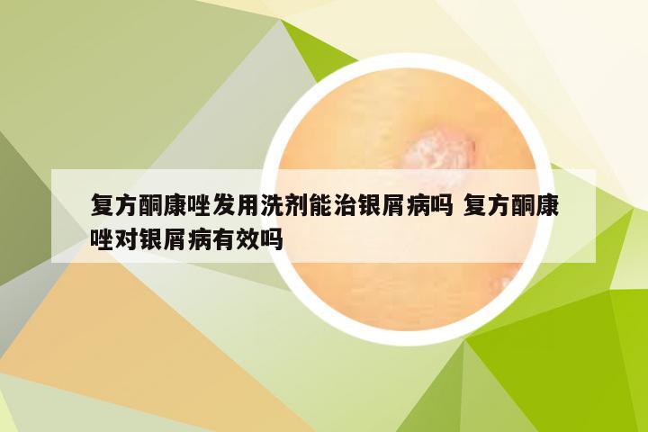 复方酮康唑发用洗剂能治银屑病吗 复方酮康唑对银屑病有效吗
