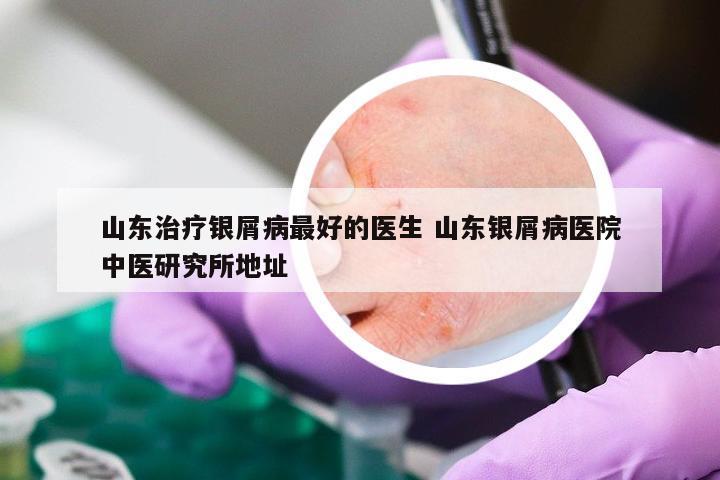 山东治疗银屑病最好的医生 山东银屑病医院中医研究所地址
