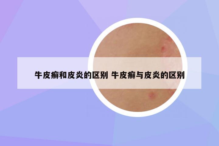 牛皮癣和皮炎的区别 牛皮癣与皮炎的区别