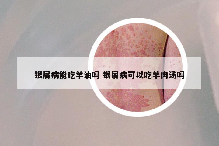银屑病能吃羊油吗 银屑病可以吃羊肉汤吗