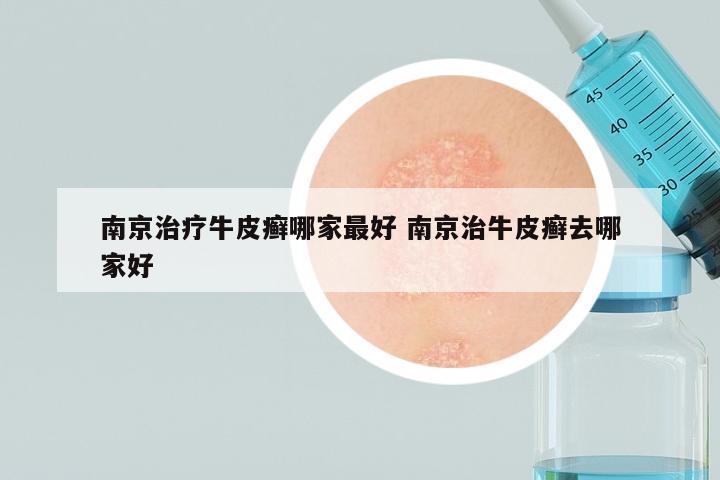 南京治疗牛皮癣哪家最好 南京治牛皮癣去哪家好