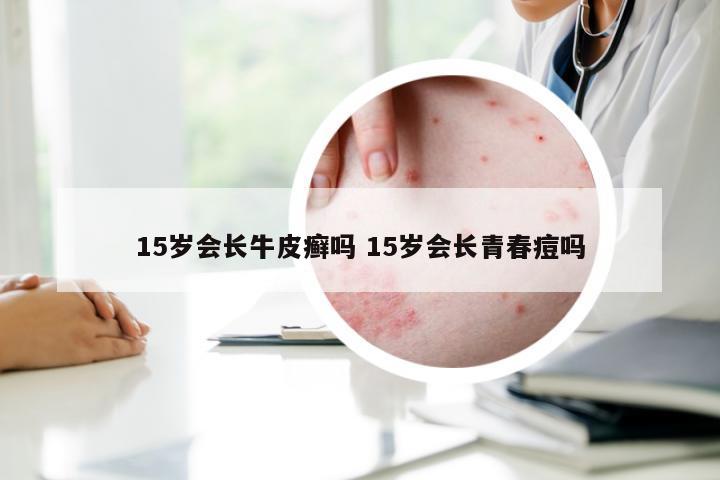 15岁会长牛皮癣吗 15岁会长青春痘吗