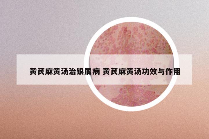 黄芪麻黄汤治银屑病 黄芪麻黄汤功效与作用