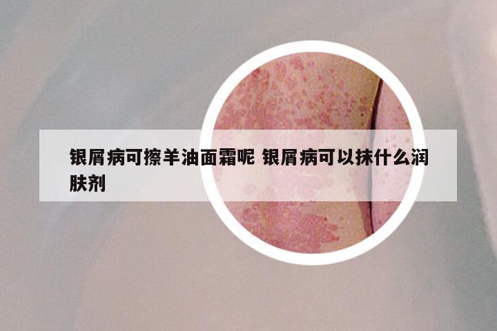 银屑病可擦羊油面霜呢 银屑病可以抹什么润肤剂
