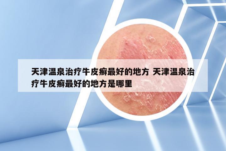 天津温泉治疗牛皮癣最好的地方 天津温泉治疗牛皮癣最好的地方是哪里