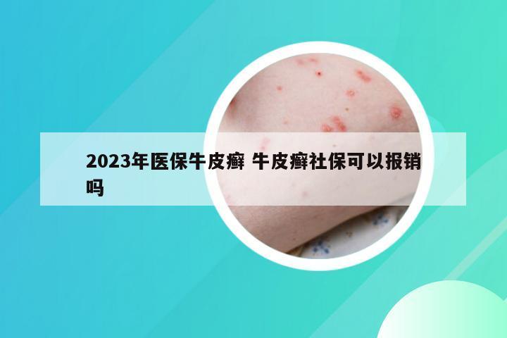 2023年医保牛皮癣 牛皮癣社保可以报销吗