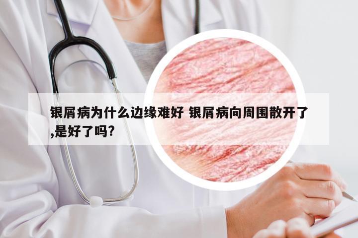 银屑病为什么边缘难好 银屑病向周围散开了,是好了吗?