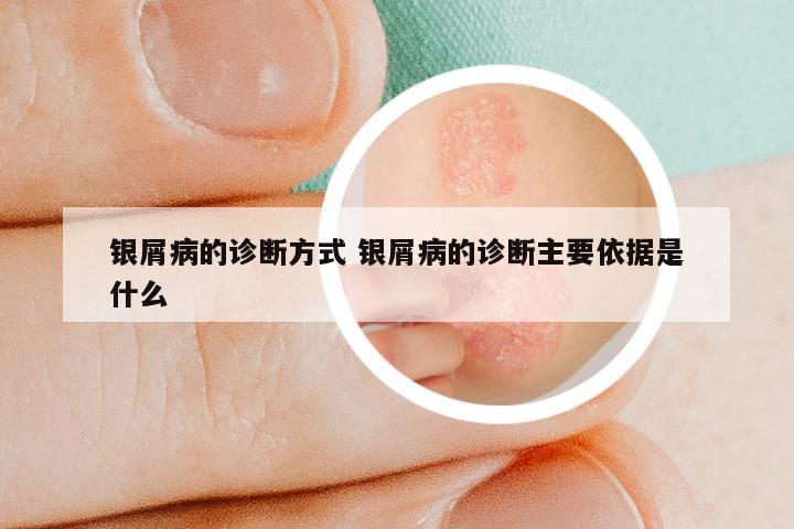 银屑病的诊断方式 银屑病的诊断主要依据是什么