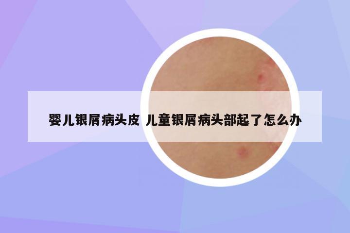 婴儿银屑病头皮 儿童银屑病头部起了怎么办