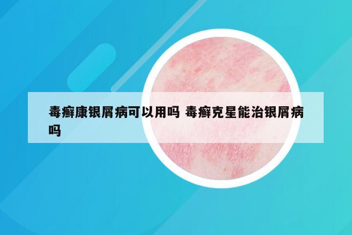 毒癣康银屑病可以用吗 毒癣克星能治银屑病吗