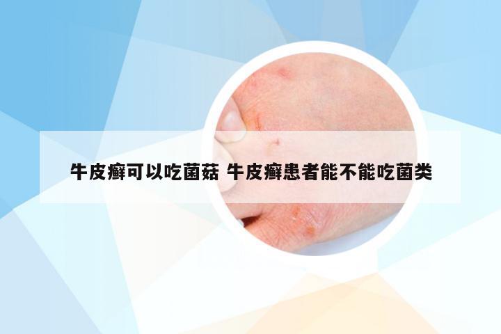 牛皮癣可以吃菌菇 牛皮癣患者能不能吃菌类
