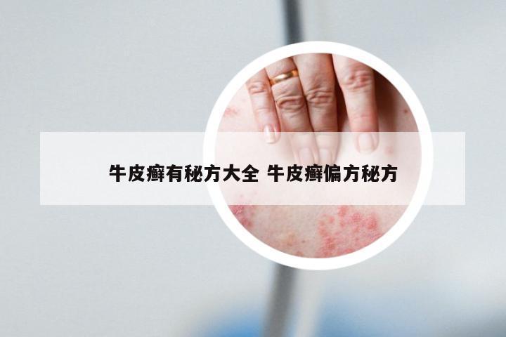 牛皮癣有秘方大全 牛皮癣偏方秘方