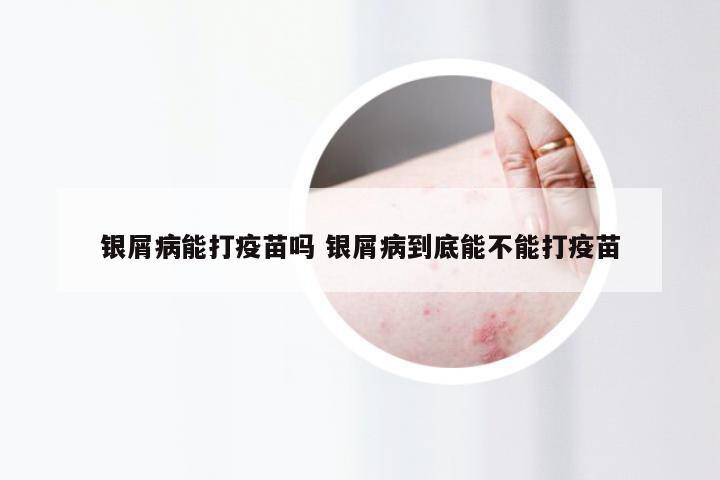银屑病能打疫苗吗 银屑病到底能不能打疫苗