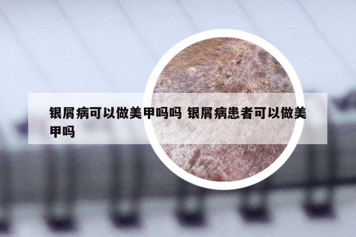 银屑病可以做美甲吗吗 银屑病患者可以做美甲吗