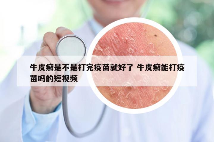 牛皮癣是不是打完疫苗就好了 牛皮癣能打疫苗吗的短视频