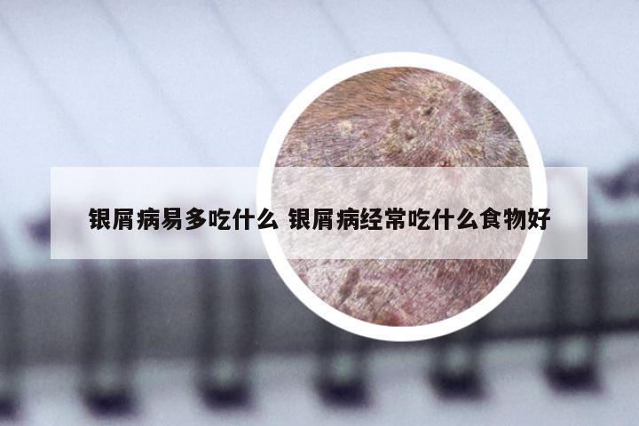 银屑病易多吃什么 银屑病经常吃什么食物好