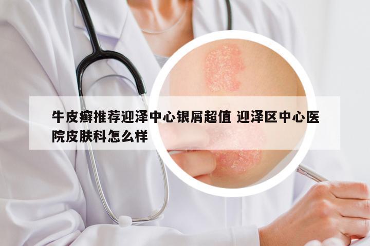 牛皮癣推荐迎泽中心银屑超值 迎泽区中心医院皮肤科怎么样