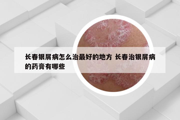 长春银屑病怎么治最好的地方 长春治银屑病的药膏有哪些