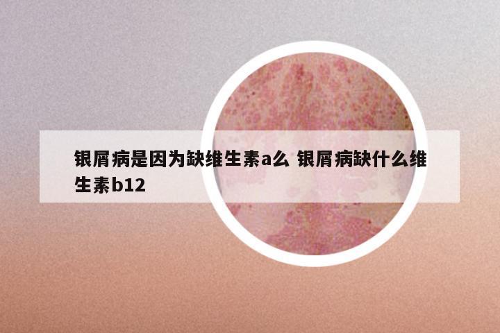 银屑病是因为缺维生素a么 银屑病缺什么维生素b12