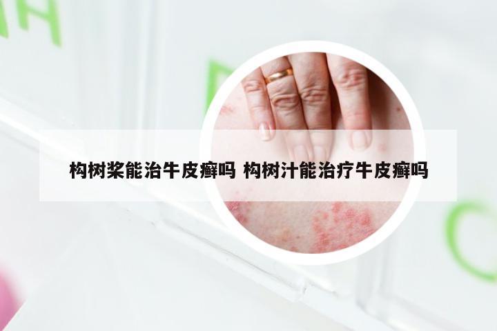 构树桨能治牛皮癣吗 构树汁能治疗牛皮癣吗