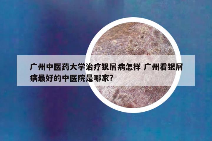 广州中医药大学治疗银屑病怎样 广州看银屑病最好的中医院是哪家?