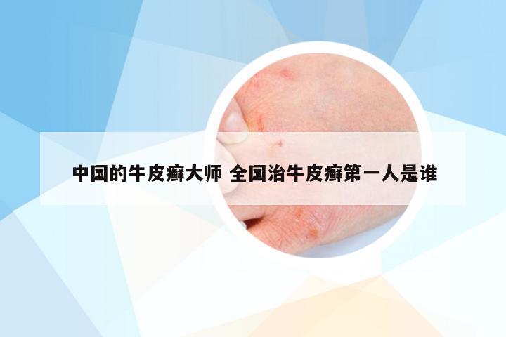 中国的牛皮癣大师 全国治牛皮癣第一人是谁