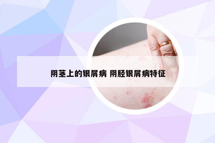 阴茎上的银屑病 阴胫银屑病特征