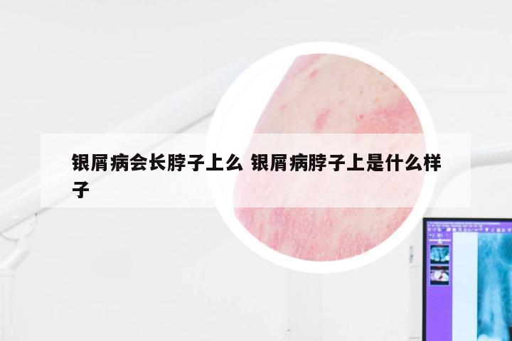 银屑病会长脖子上么 银屑病脖子上是什么样子