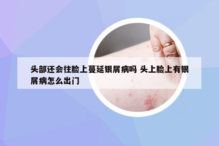 头部还会往脸上蔓延银屑病吗 头上脸上有银屑病怎么出门