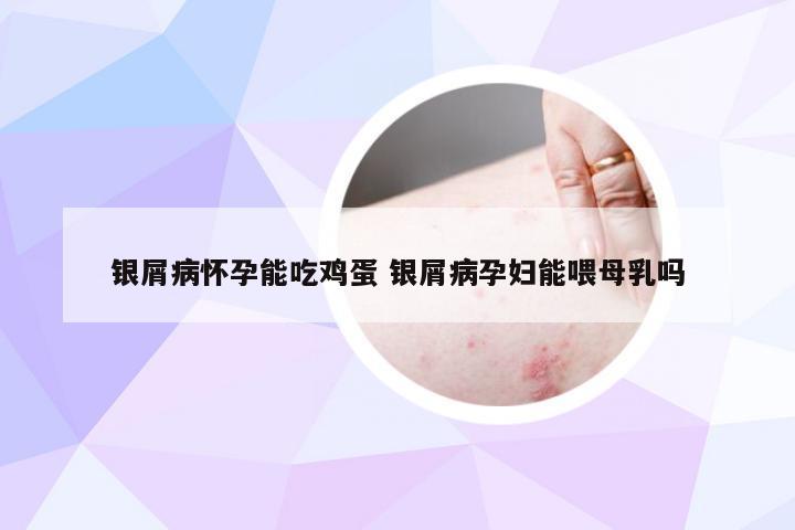 银屑病怀孕能吃鸡蛋 银屑病孕妇能喂母乳吗