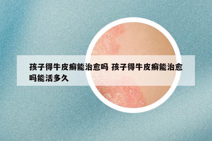 孩子得牛皮癣能治愈吗 孩子得牛皮癣能治愈吗能活多久