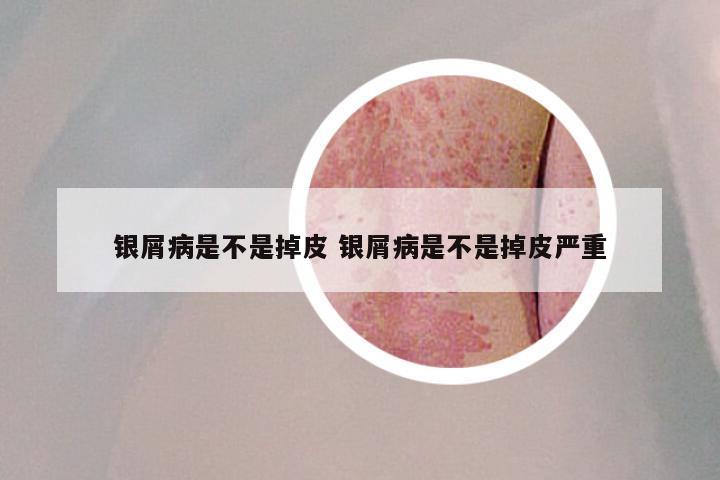 银屑病是不是掉皮 银屑病是不是掉皮严重