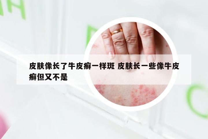 皮肤像长了牛皮癣一样斑 皮肤长一些像牛皮癣但又不是