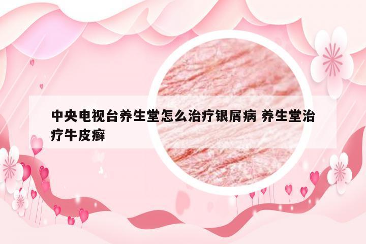 中央电视台养生堂怎么治疗银屑病 养生堂治疗牛皮癣