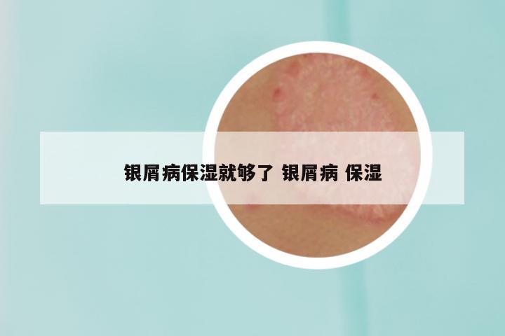 银屑病保湿就够了 银屑病 保湿
