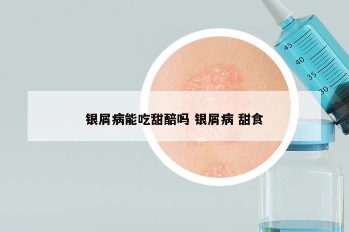 银屑病能吃甜醅吗 银屑病 甜食