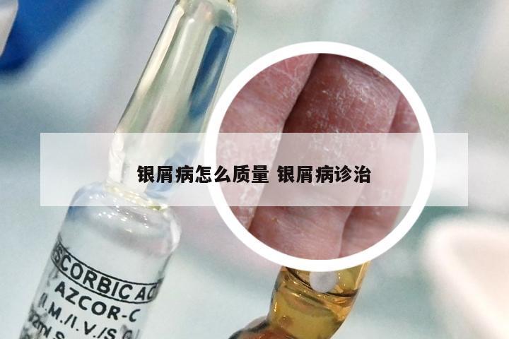银屑病怎么质量 银屑病诊治