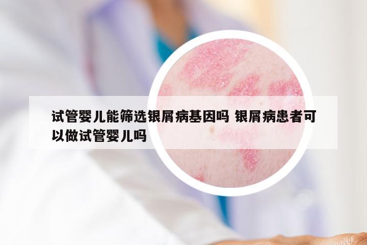 试管婴儿能筛选银屑病基因吗 银屑病患者可以做试管婴儿吗