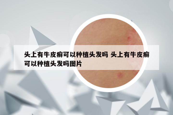头上有牛皮癣可以种植头发吗 头上有牛皮癣可以种植头发吗图片